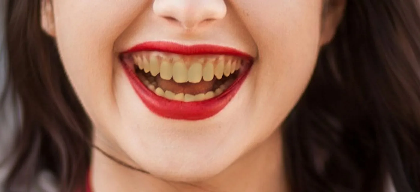 Sonrisa antes del tratamiento: esmalte opaco y amarillento