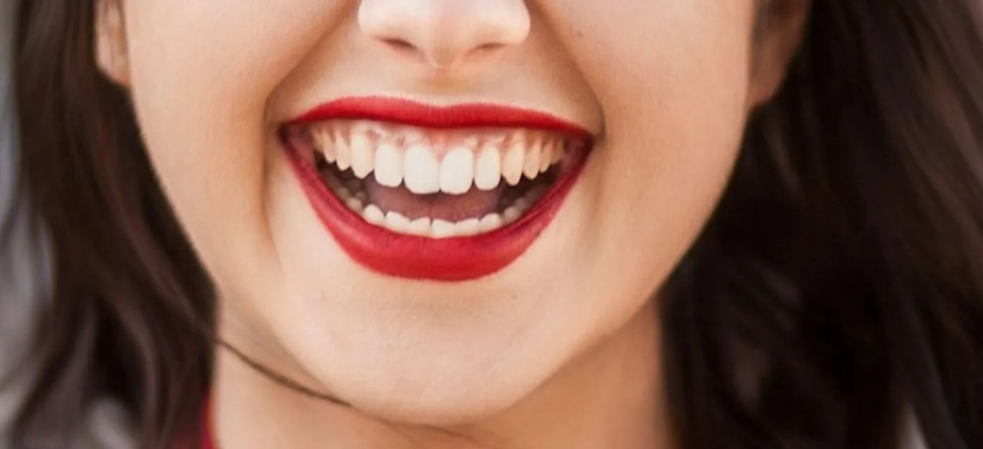 La misma sonrisa después del tratamiento: blanca y luminosa